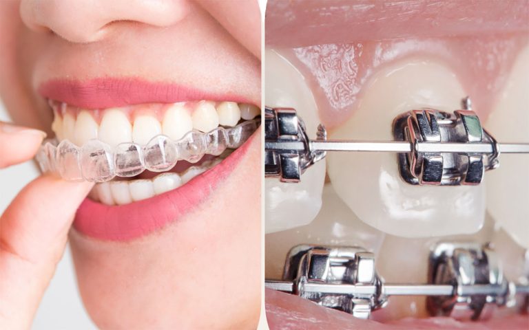 Invisalign-Dis-Telleri